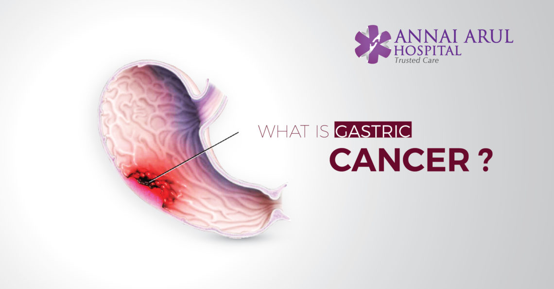 WHAT IS GASTRIC CANCER Multispeciality Hospitals In Chennai what-is-gastric-cancer-multispeciality-hospitals-in-chennai