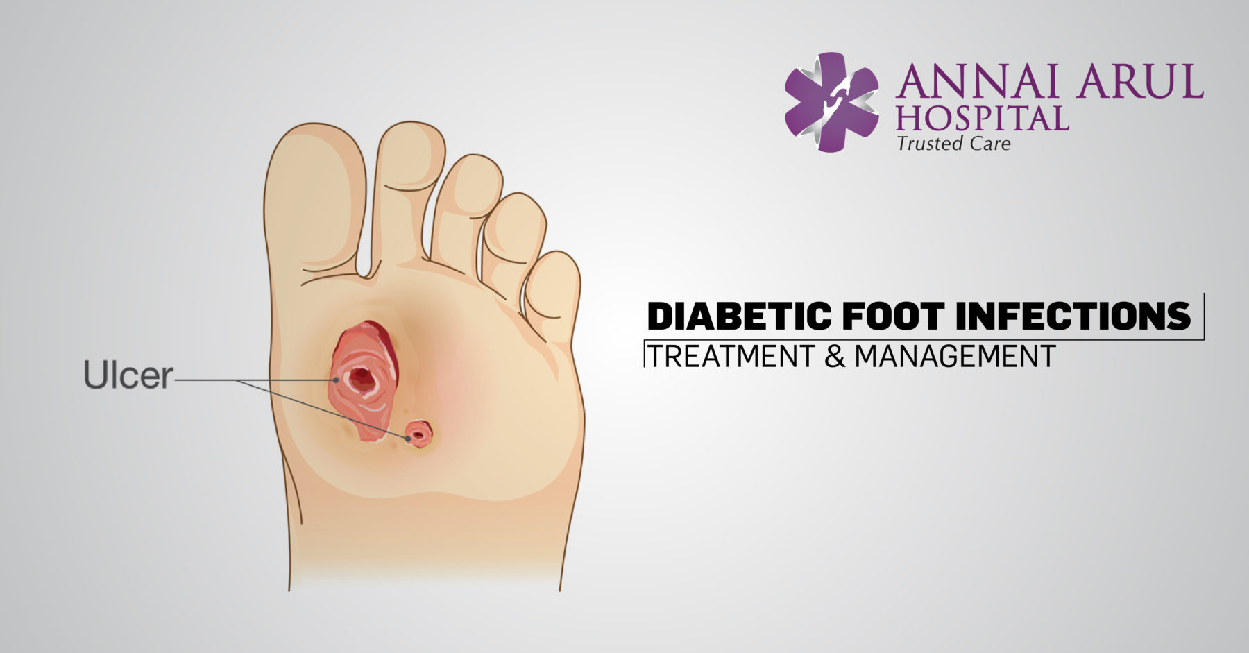 Research for the Future - MIDFUT: Multiple Interventions for Diabetic Foot  Ulcer Treatment This study is looking at a number of different treatments  for people with diabetic foot ulcers and trying them